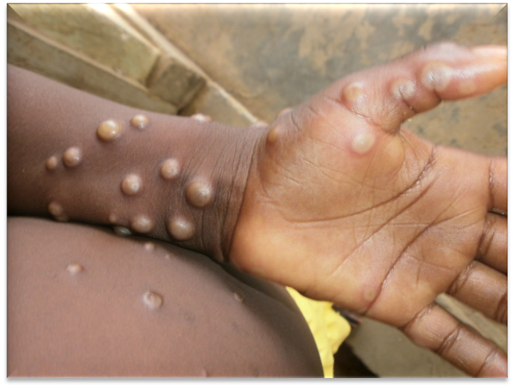 W.H.O. DECLARES MONKEYPOX SPREAD A GLOBAL HEALTH EMERGENCY