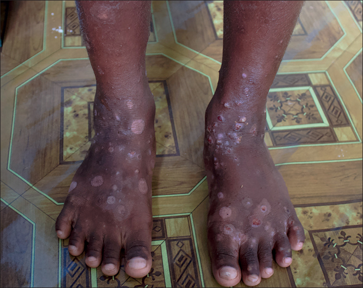 Scabies breaks out in Kalabo district