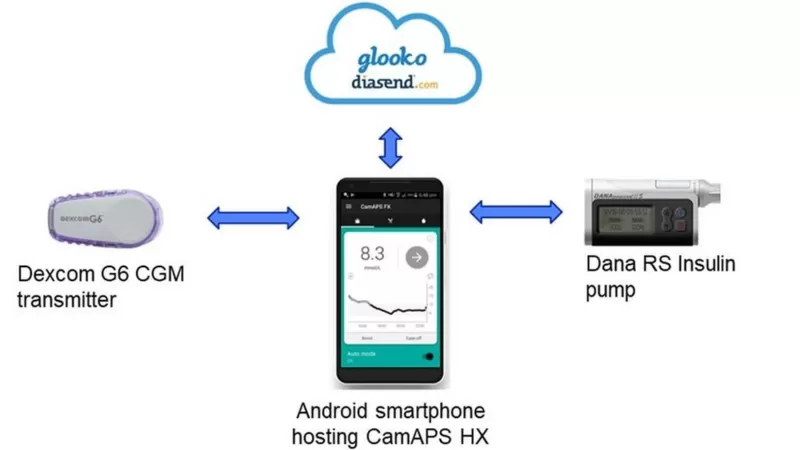 Cambridge University researchers trial artificial pancreas in type 2 diabetics