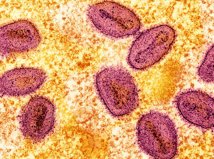 Philippines detects first mpox case this year, yet to determine strain